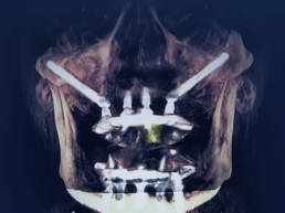 Implante Zigomático