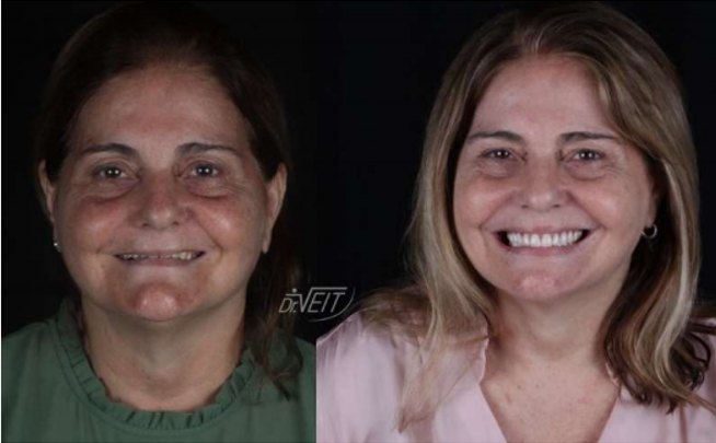 Implante Zigomático