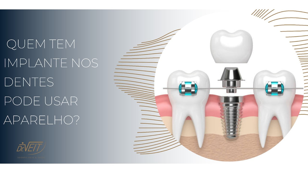 Quem tem implante pode usar aparelho