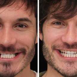 Eliezer antes e depois tratamento dentario